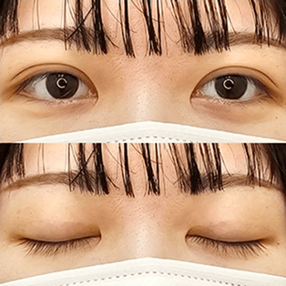 自然癒着法の症例写真