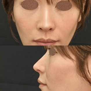 鼻整形の症例写真