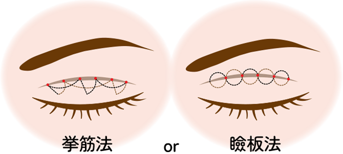 自然癒着法の縫い方