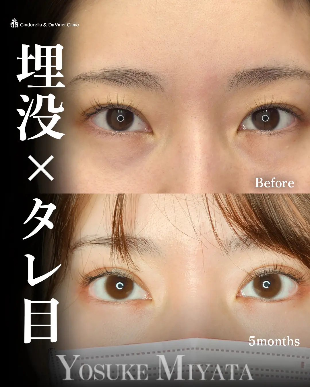 二重手術の症例