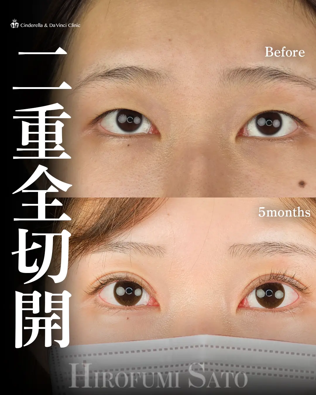 二重手術の症例