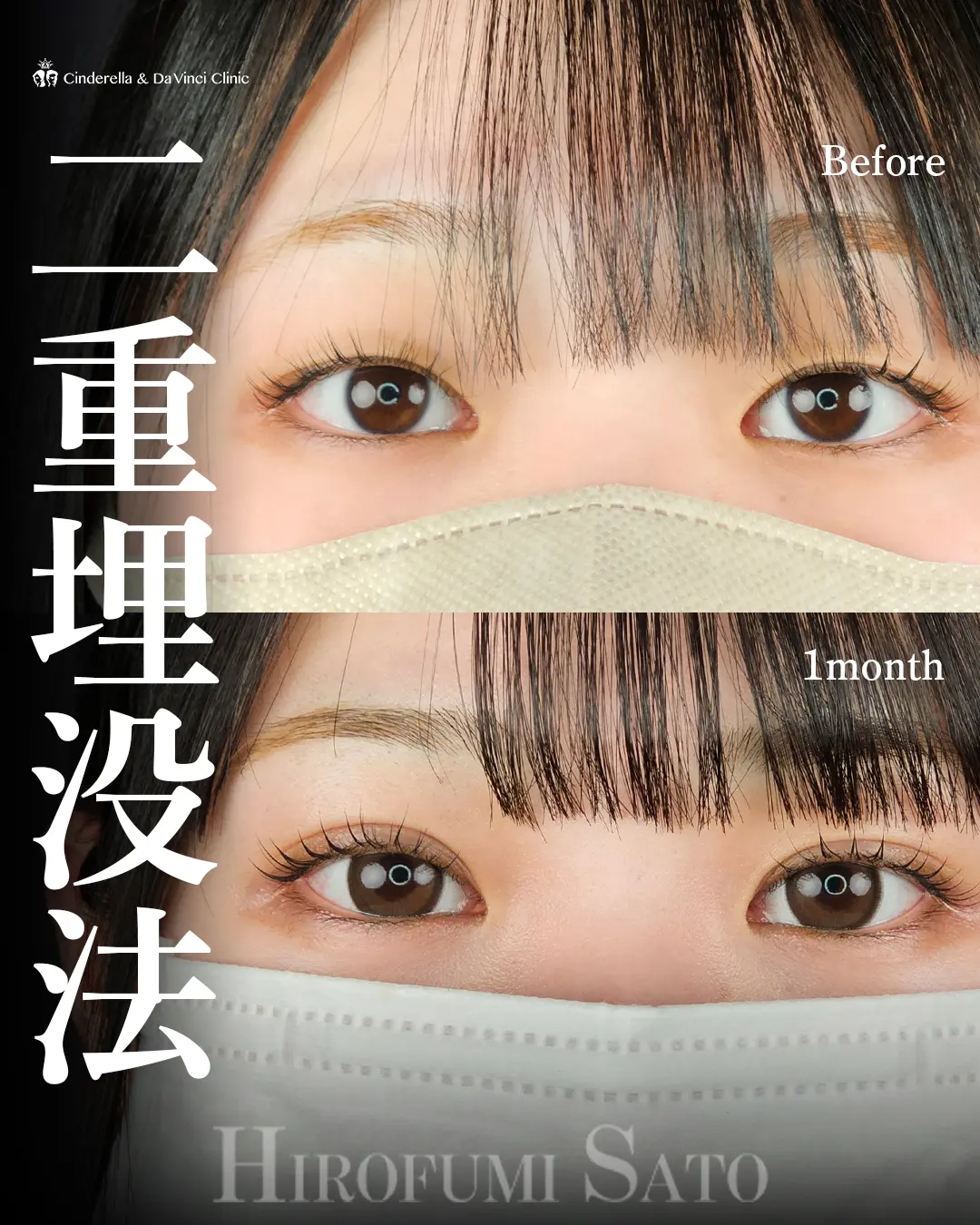 二重手術の症例