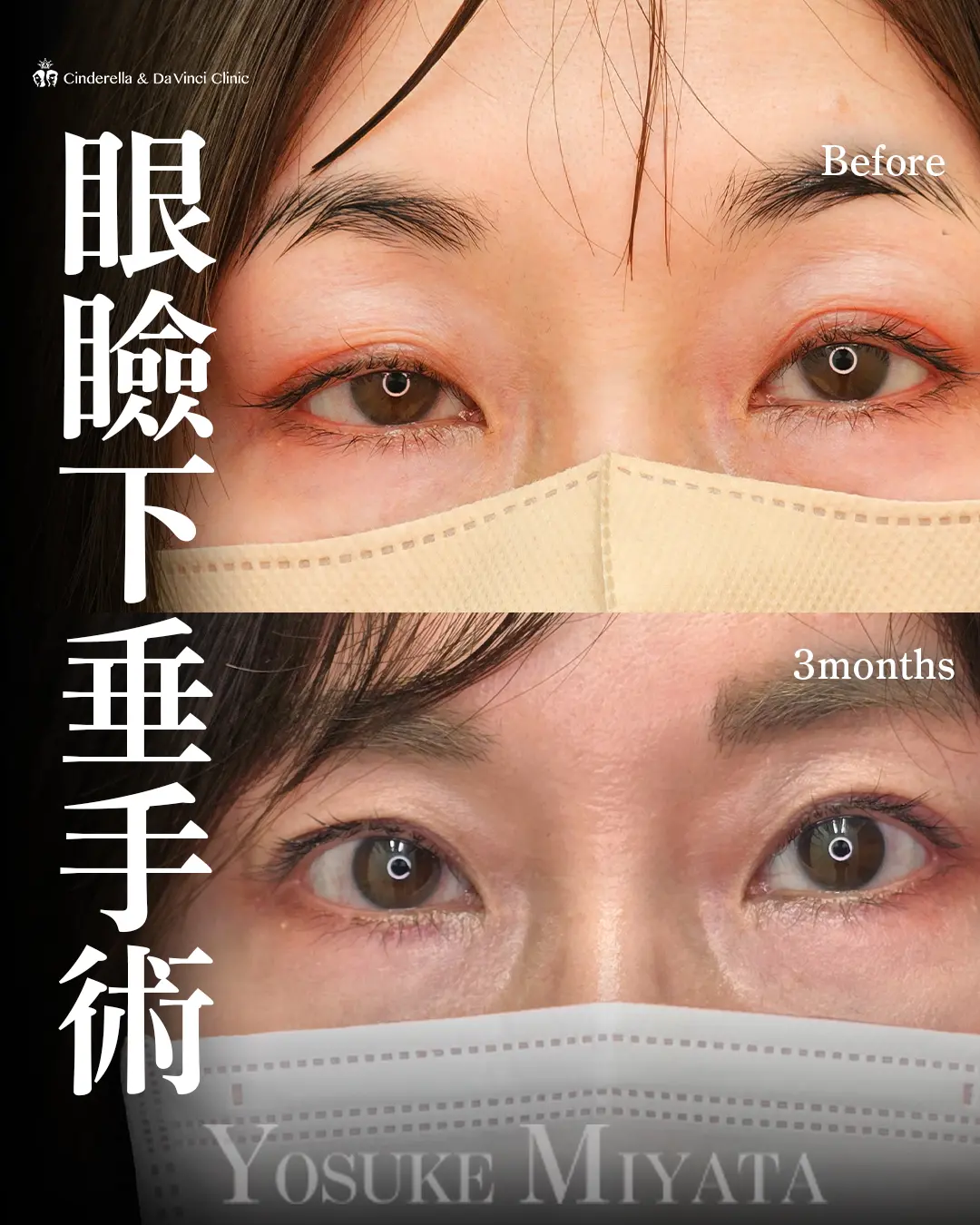 二重手術の症例