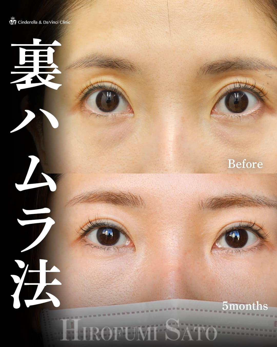 目の下のクマ取り(裏ハムラ法)※佐藤先生