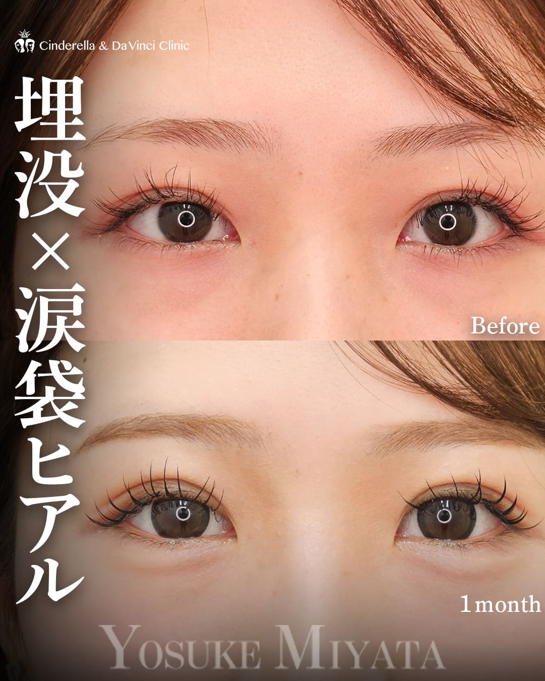 二重埋没法(自然癒着法(瞼板法))×涙袋ヒアルセット