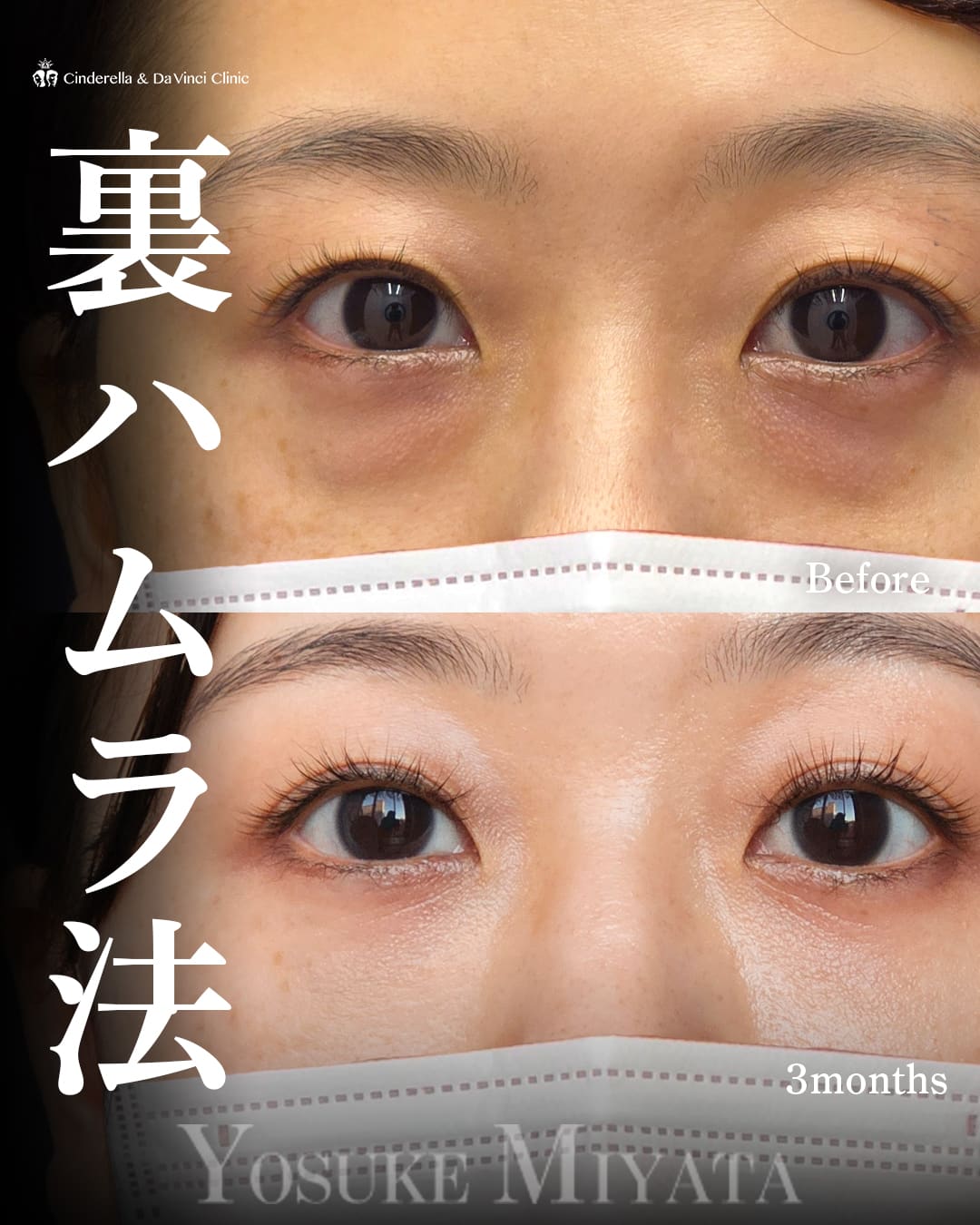 目の下のクマ取り(裏ハムラ法)