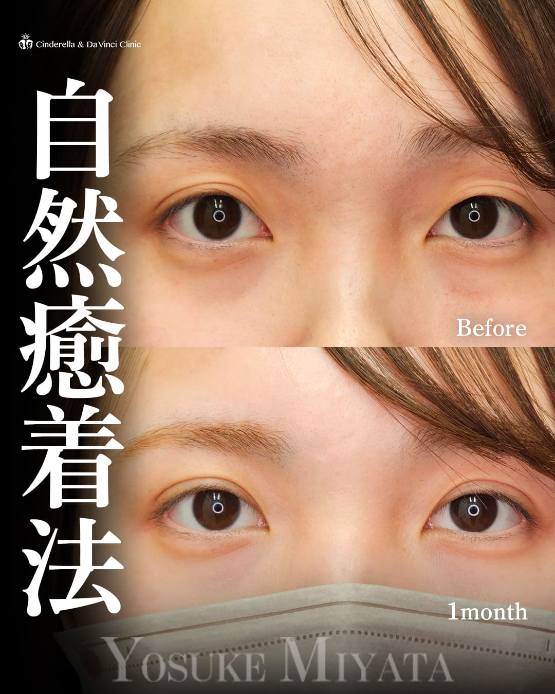 二重埋没法（自然癒着法(挙筋法)）