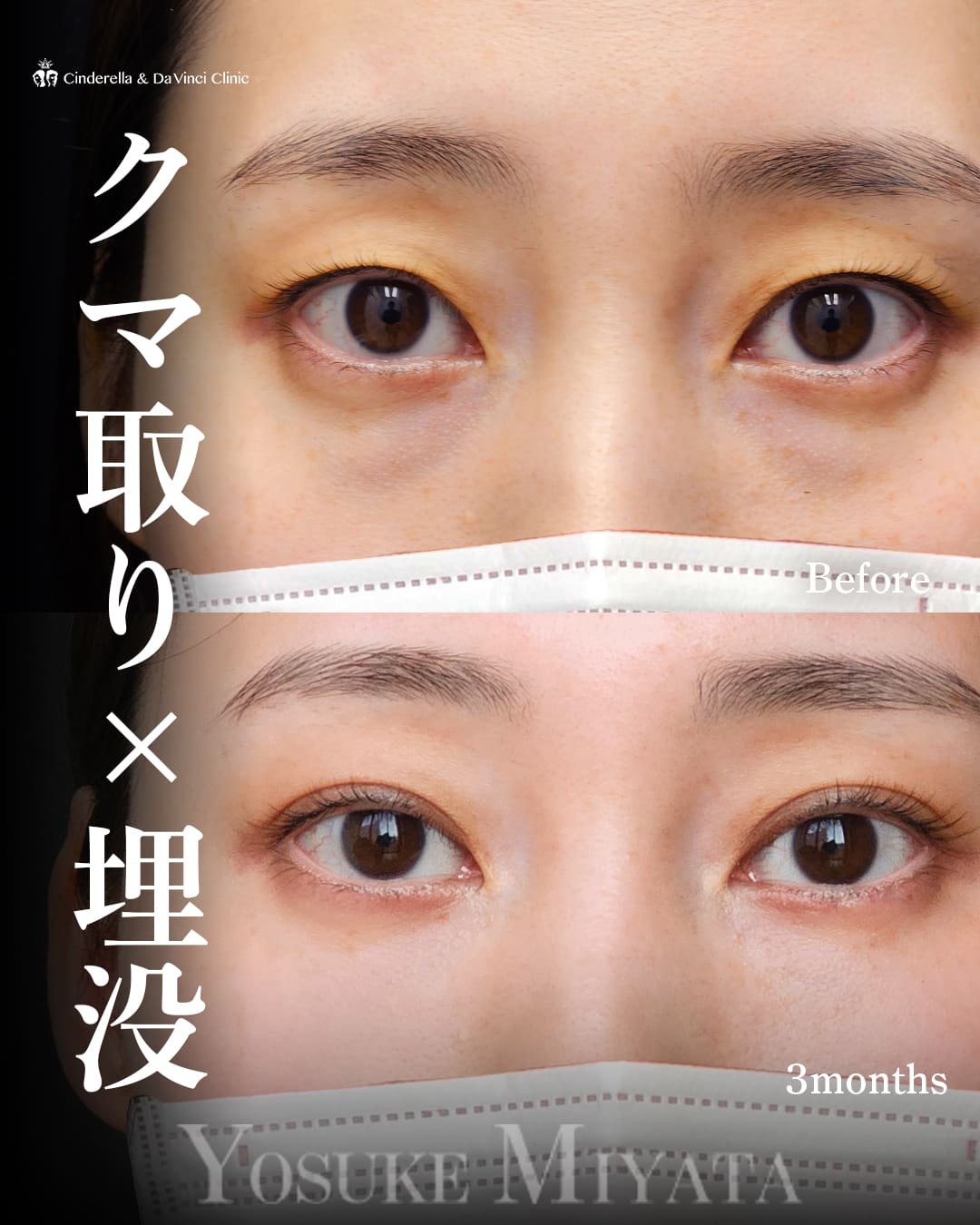 目の下のクマ取り(裏ハムラ法)×二重埋没法(自然癒着法(挙筋法))