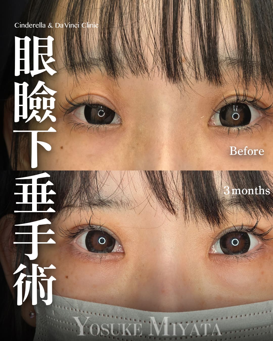 眼瞼下垂併用全切開