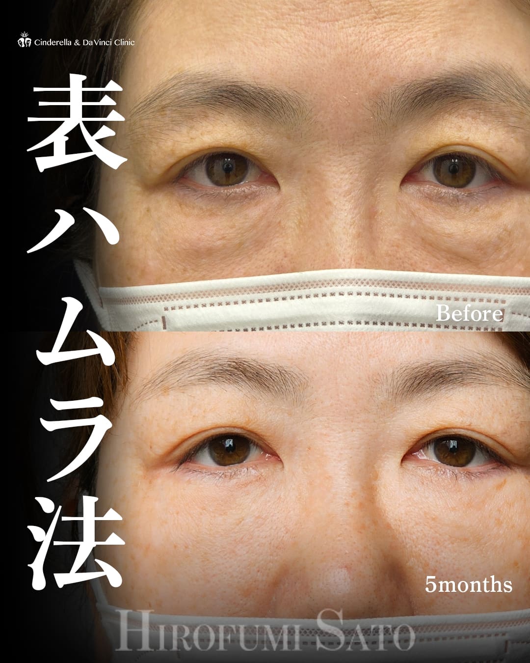 目の下のクマ取り(表ハムラ法)※佐藤先生