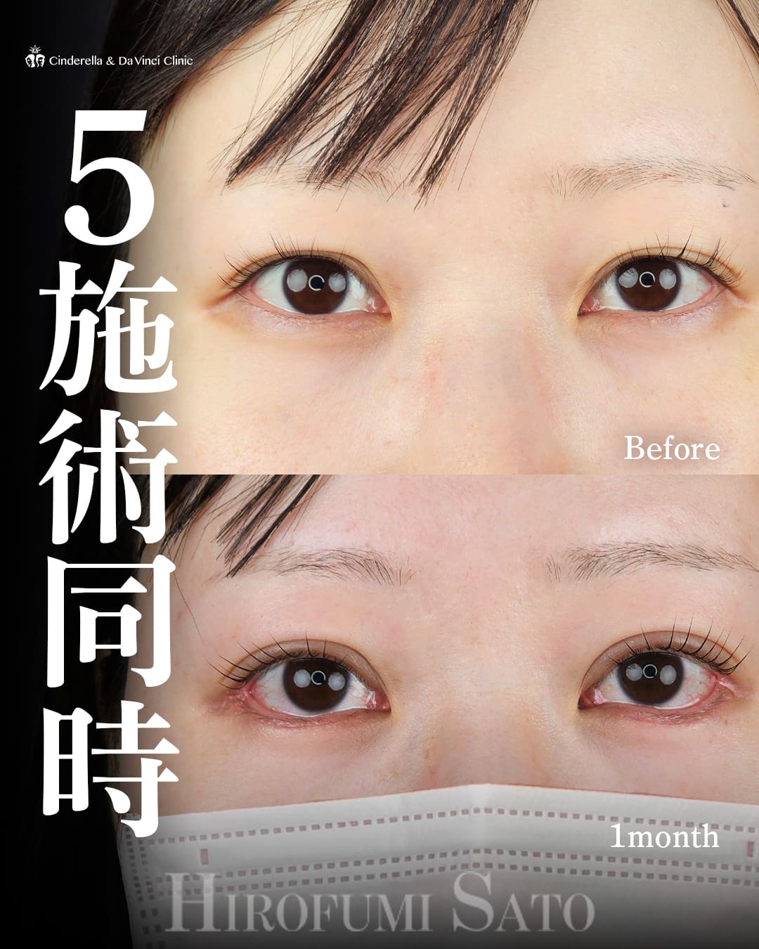 自然癒着法・まぶたの脂肪取り・タレ目手術・目尻切開・目の下の脂肪取り※佐藤先生