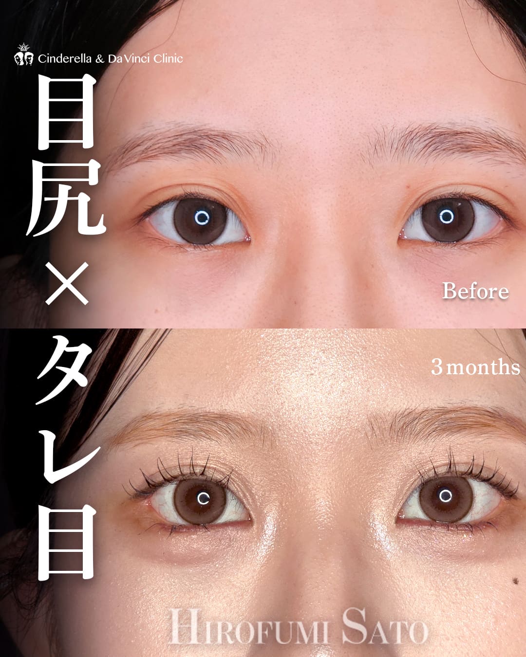 タレ目手術(グラマラスライン形成)×目尻切開※佐藤先生