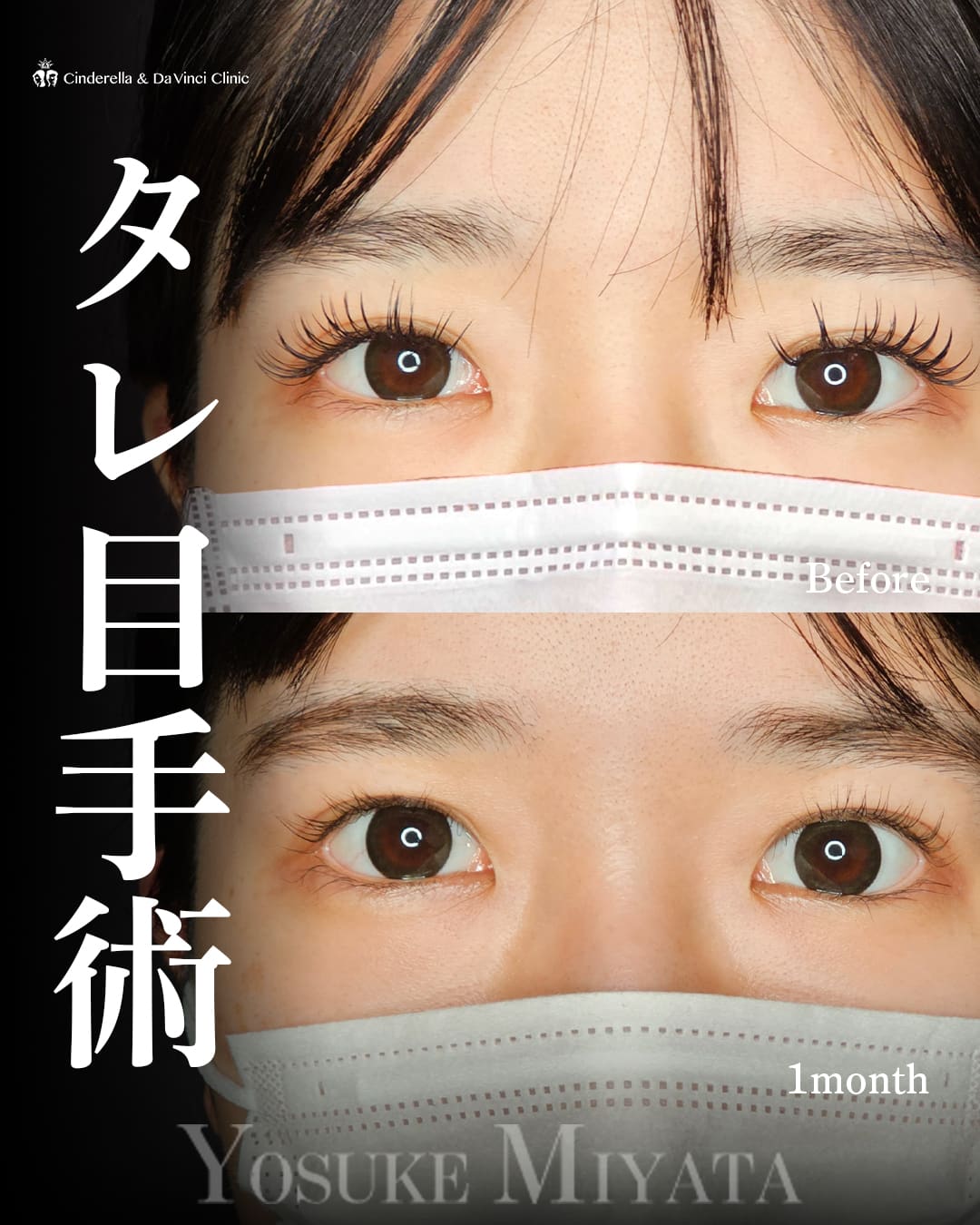 タレ目手術(グラマラスライン形成)