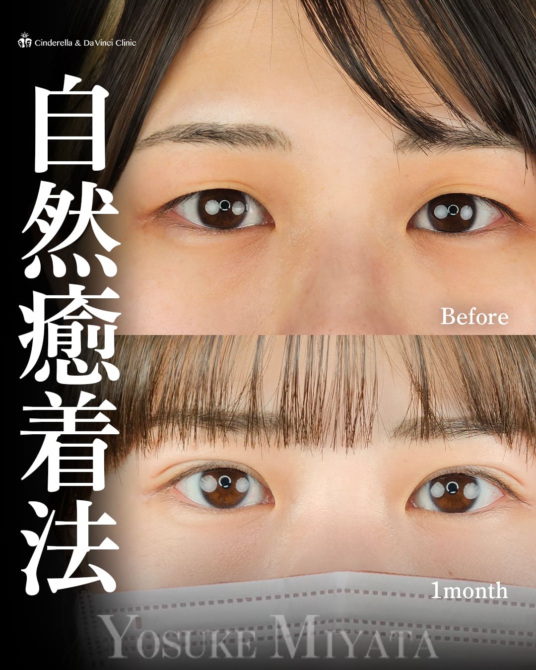 二重埋没法（自然癒着法(挙筋法)）