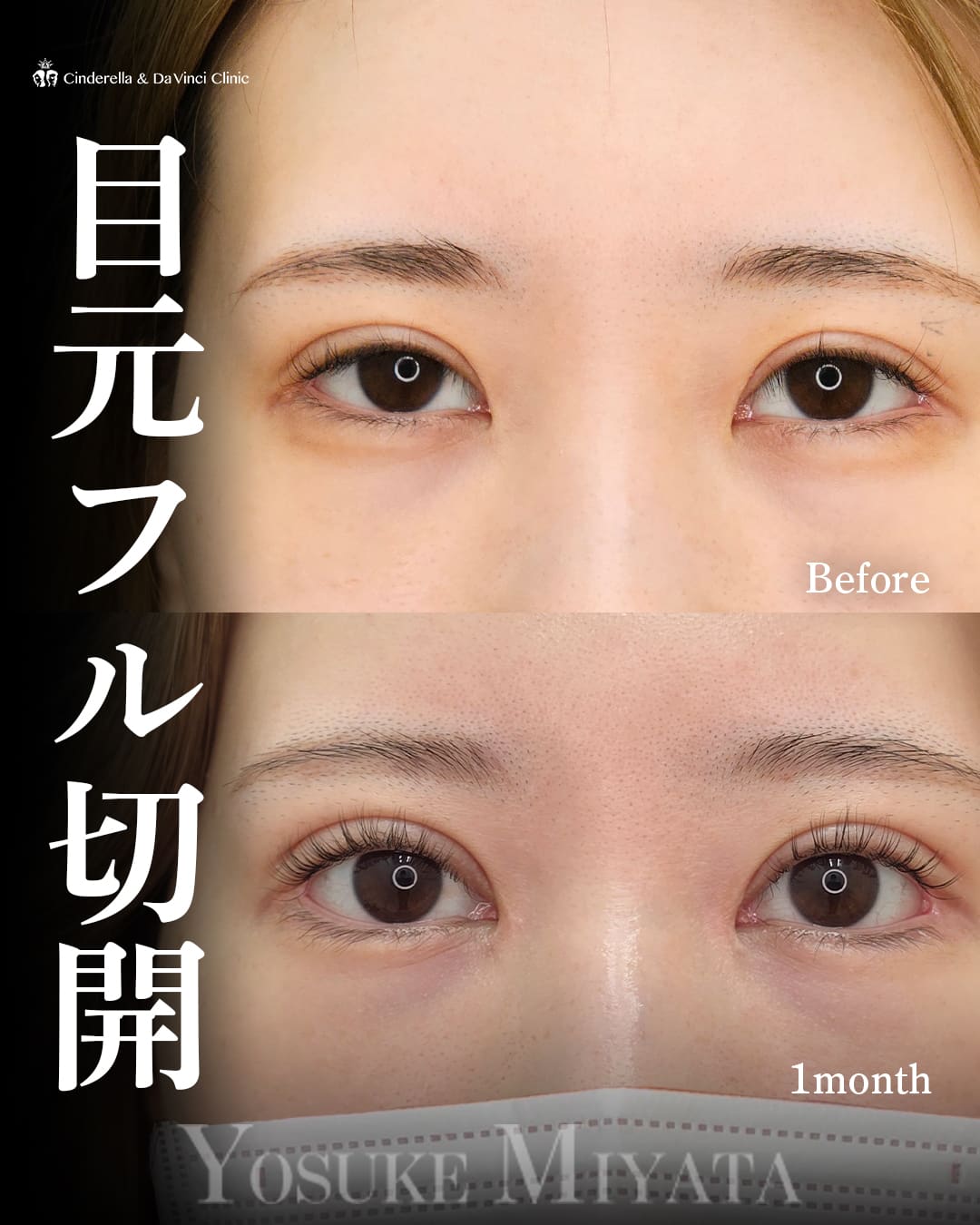 眼瞼下垂併用全切開・目頭切開・タレ目手術・目尻切開(左目のみ)・他院修正