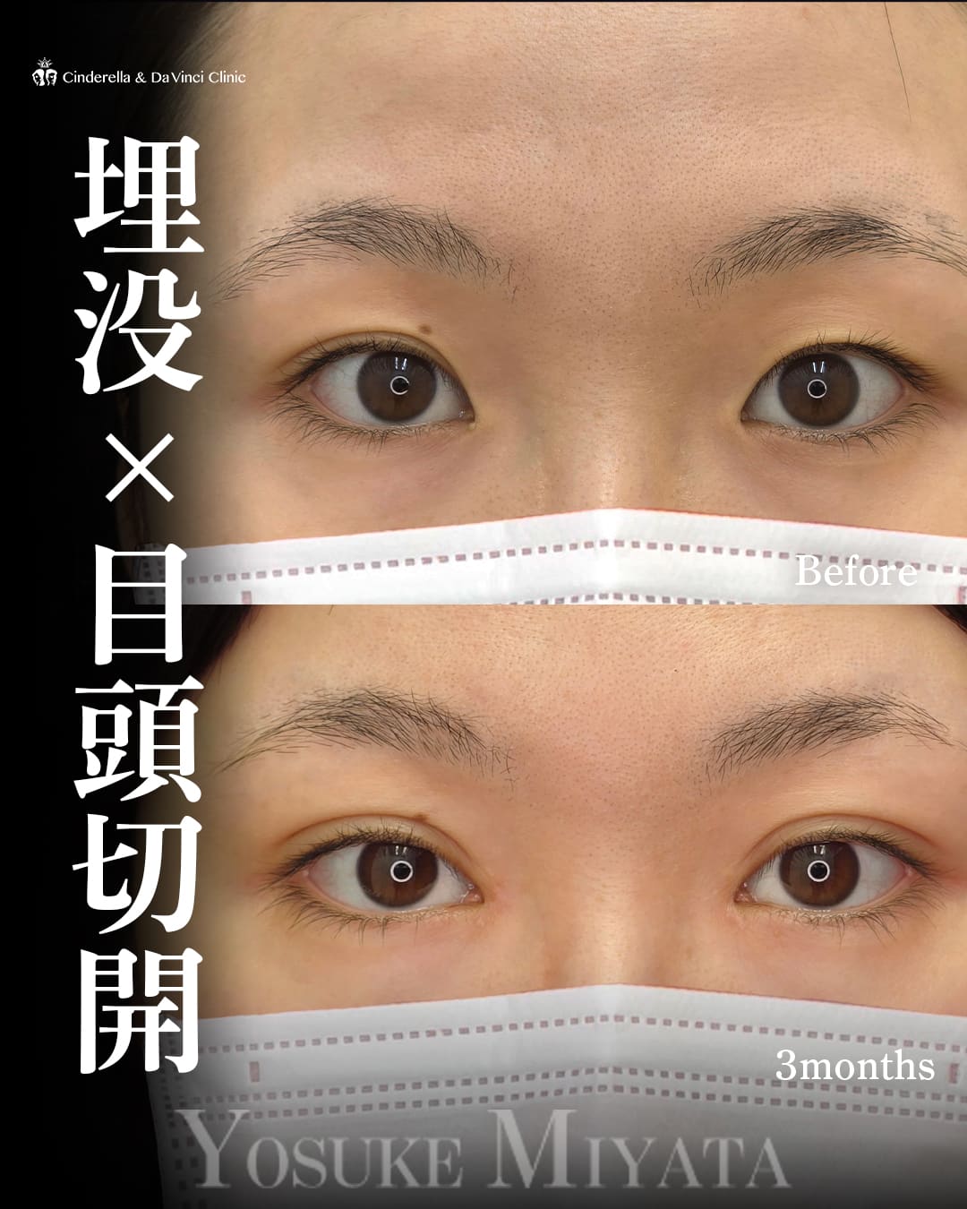 二重埋没法(自然癒着法(挙筋法))・目頭切開(二重施術と同時)