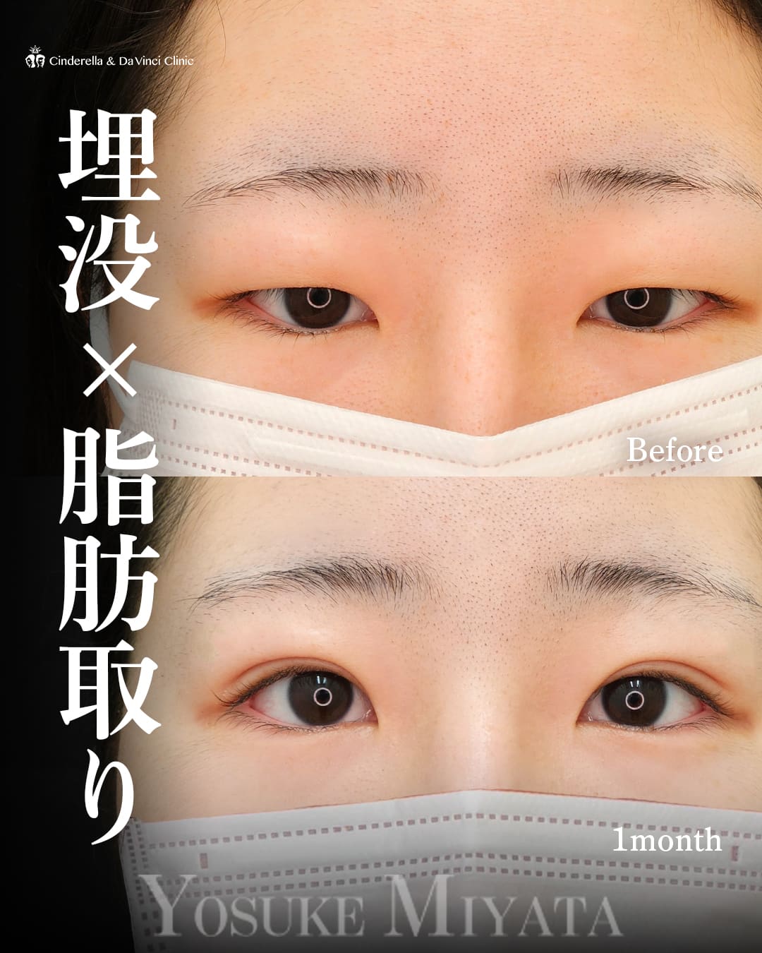 二重埋没法(自然癒着法(瞼板法))×まぶたの脂肪取り