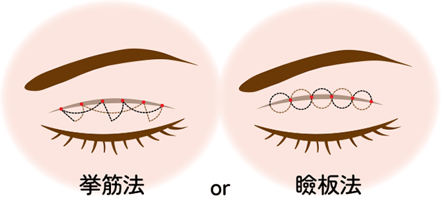 宮田式二重施術（自然癒着法）