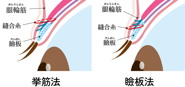 瞼板法と挙筋法