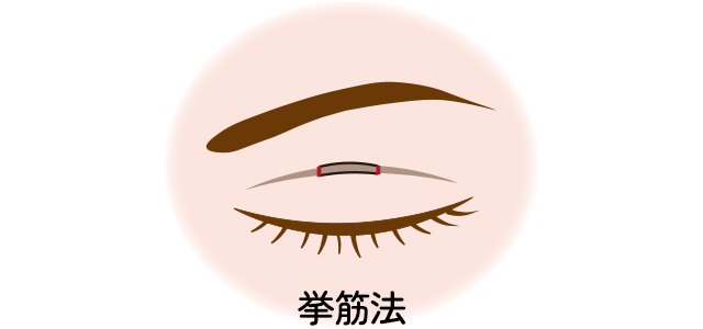 シングルループ