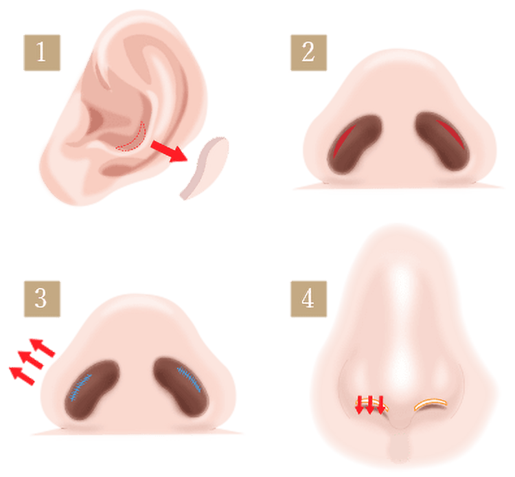 鼻孔縁下降術の施術方法