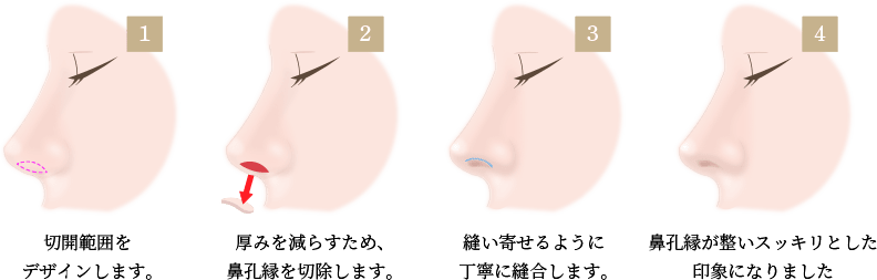 鼻孔縁挙上術の施術方法