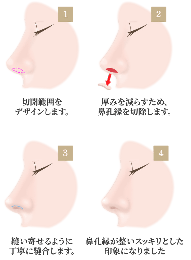 鼻孔縁挙上術の施術方法