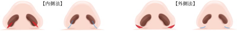 鼻翼縮小術の施術方法