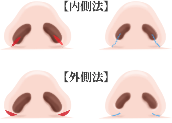 鼻翼縮小術の施術方法