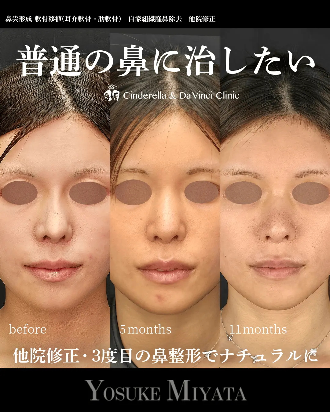 普通の鼻に治したい