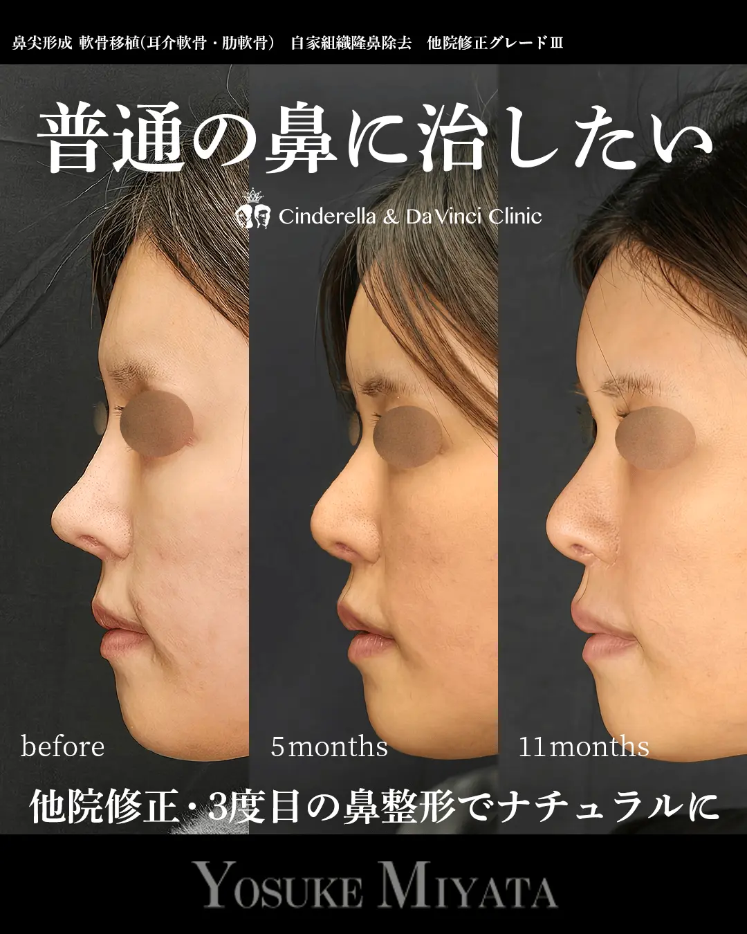 普通の鼻に治したい