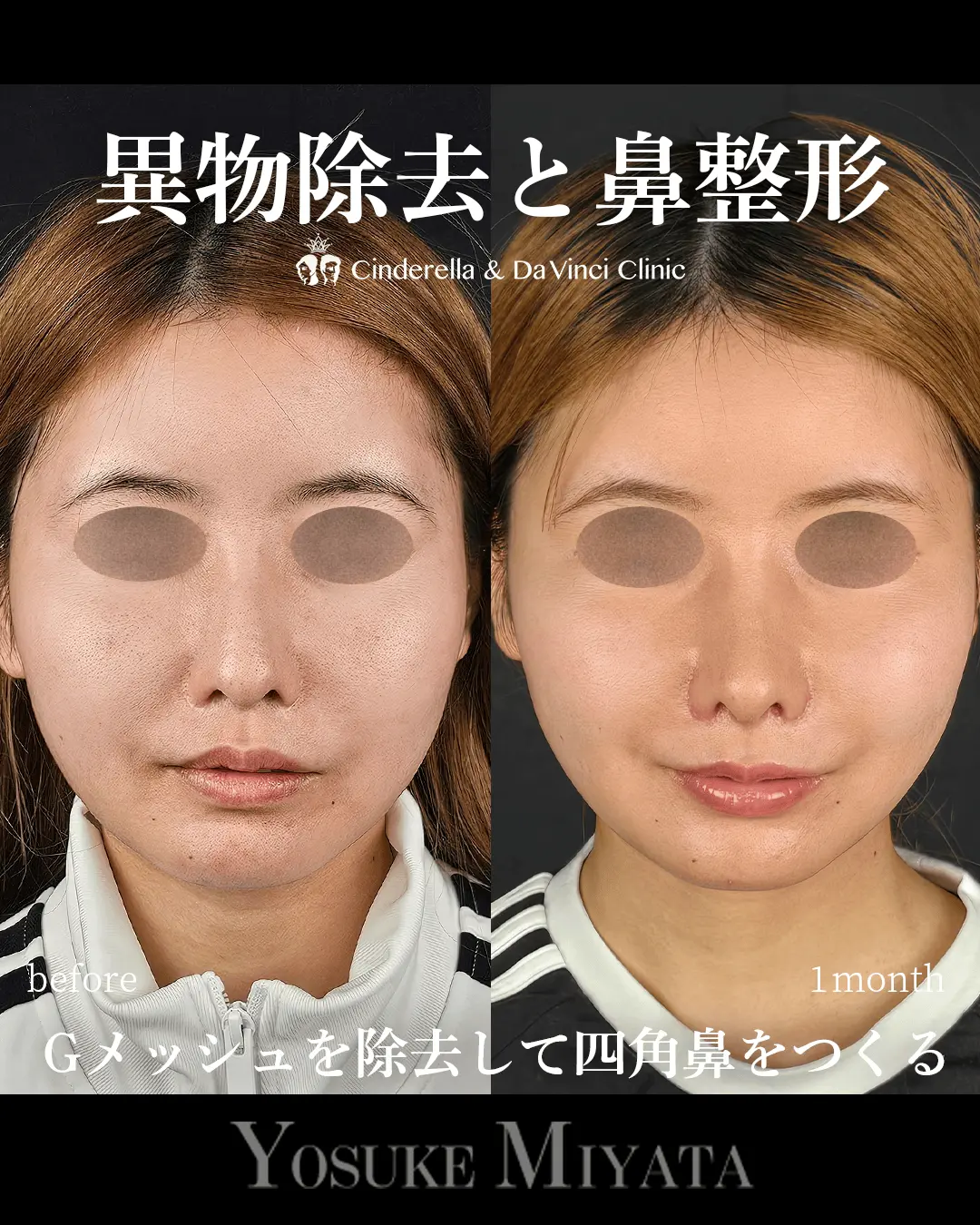 異物除去と鼻整形