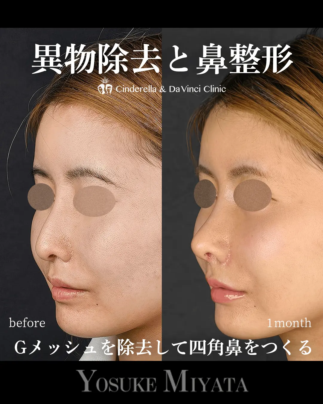 異物除去と鼻整形