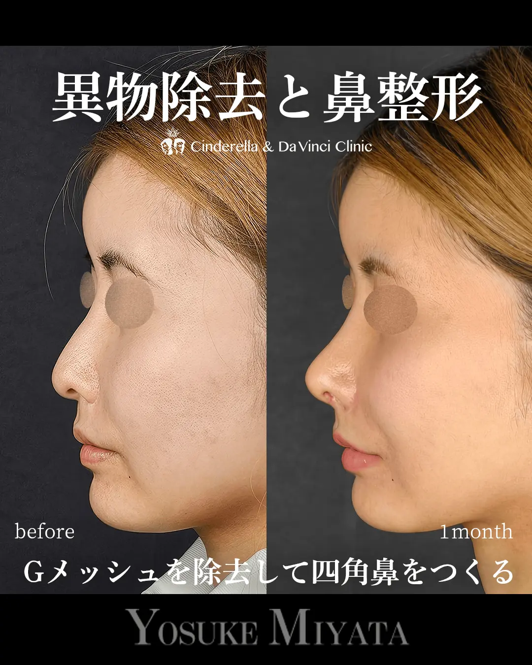 異物除去と鼻整形