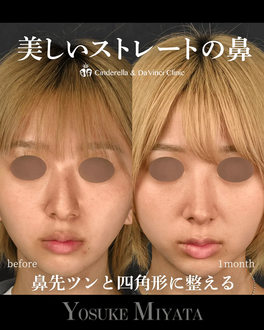 美しいストレートの鼻