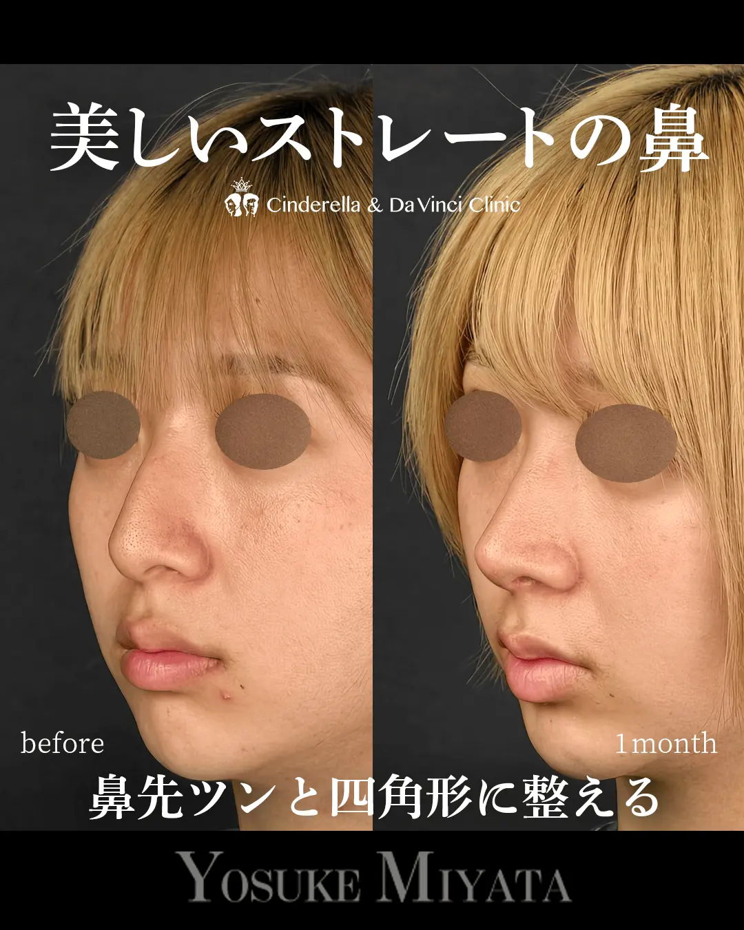 美しいストレートの鼻