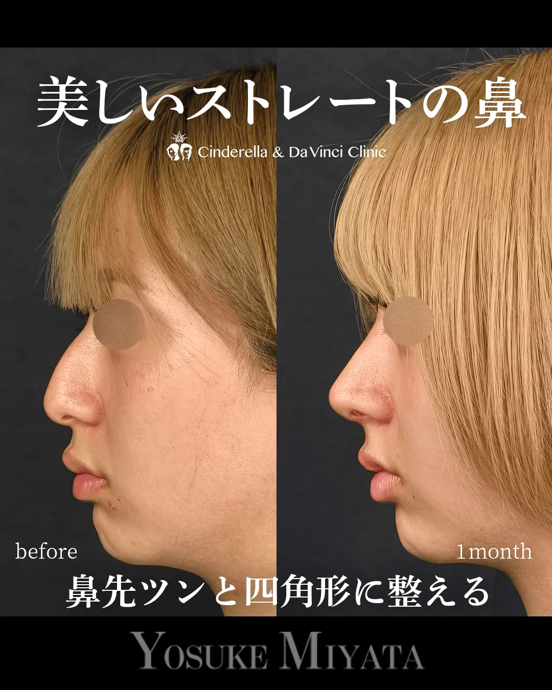 美しいストレートの鼻