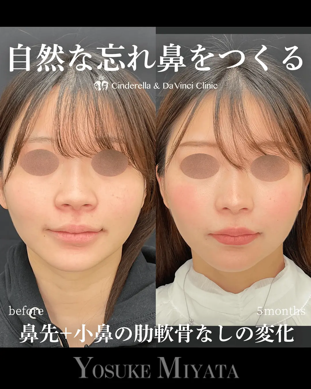 自然な忘れ鼻をつくる