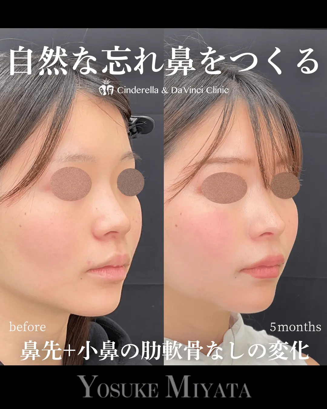 自然な忘れ鼻をつくる