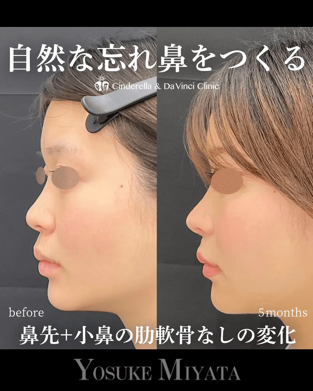 自然な忘れ鼻をつくる