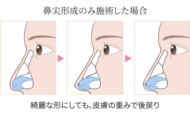 鼻尖形成のみ施術した場合
