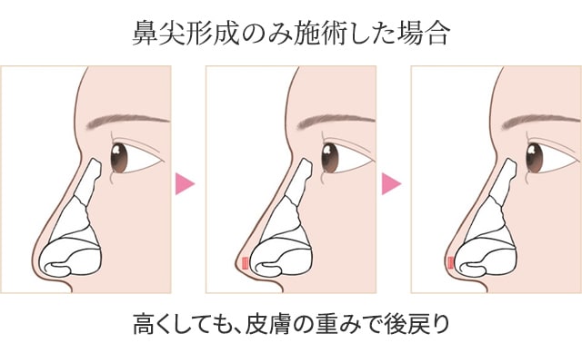 耳介軟骨移植のみ施術した場合