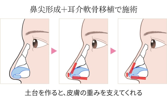 鼻尖形成+耳介軟骨移植で施術