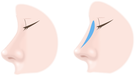 プロテーゼの施術方法