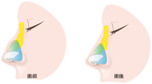 鷲鼻修正の施術方法