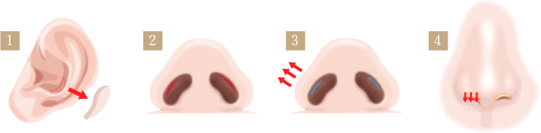 鼻孔縁下降術の画像