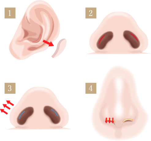 鼻孔縁下降術の画像