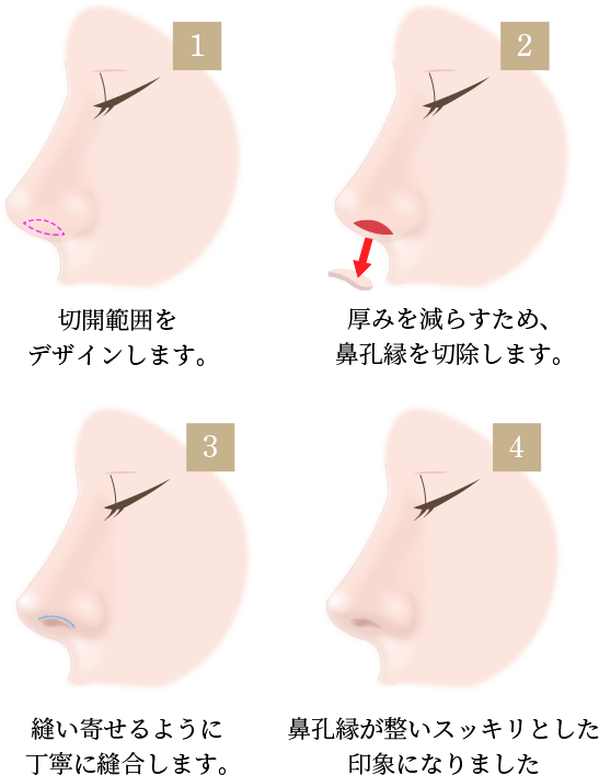 鼻孔縁挙上術の画像