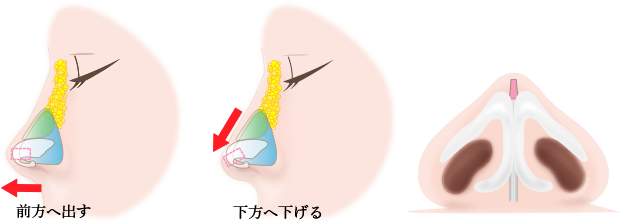 鼻中隔延長の画像