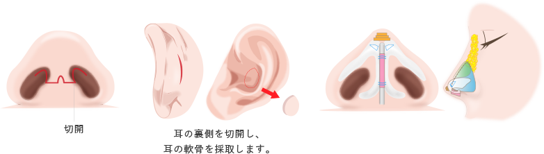 耳介軟骨移植の画像